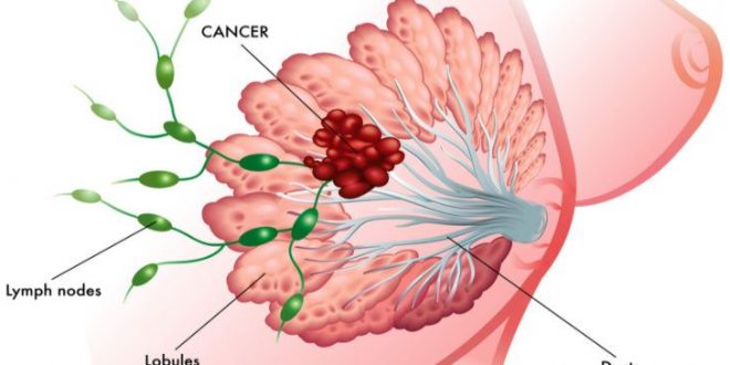 شایع ترین سرطان در زنان ایران سرطان های کشنده در زنان انواع سرطان زنان علائم سرطان در زنان پاورپوینت شایع ترین سرطان در زنان شایع ترین سرطان در زنان چیست