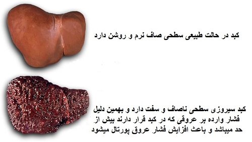 Znalezione obrazy dla zapytania علایم بیماری چربی کبد و راههای درمان
