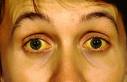 یرقان (زردی)(Icterus و jaundice)