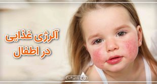 آلرژی غذایی در اطفال