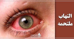 التهاب ملتحمه چشم