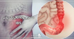 سندرم روده تحریک پذیر (IBS)