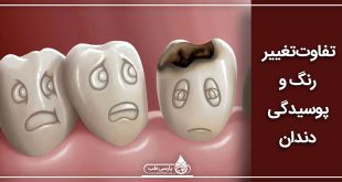 فرق پوسیدگی و تغییر رنگ دندان