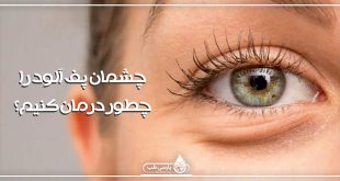 چشمان پف آلود را چطور درمان کنیم؟
