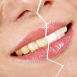 فرق پوسیدگی و تغییر رنگ دندان