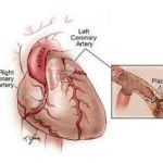 انواع درمان برای بیماری گرفتگی عروق قلب