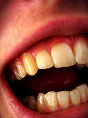 چرا رنگ دندانهاي بعضي افراد زرد است؟