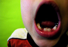 مهمترین عامل پوسیدگی دندان در کودکان کشف شد