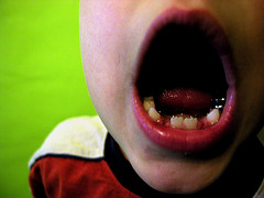 مهمترین عامل پوسیدگی دندان در کودکان کشف شد