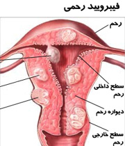 فیبروم، بیماری شایع در خانم ها