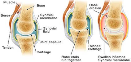 Arthritic-Joints1