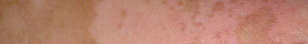 vitiligo_neck_0