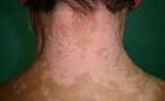 vitiligo_neck_1