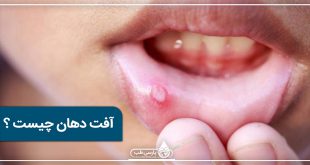 آفت دهان چیست ؟ + روش درمان