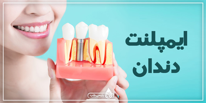 هر آنچه درباره ایمپلنت و کاشت دندان باید بدانید !