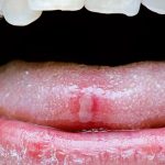 أمراض اللسان- السلاق أو التهابات الفم واللسان
