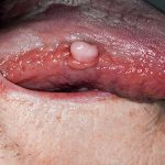 أمراض اللسان-سرطان اللسان