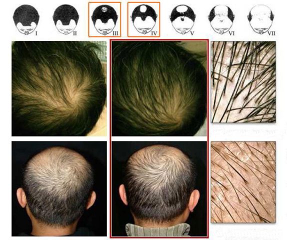 درمان ریزش مو با داروهای گیاهی ریزش موی آندروژنیک