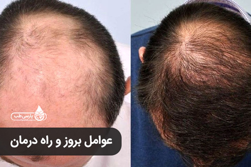 عوامل بروز و راه درمان ریزش موی سکه ای ( آلوپسی آره آتا ) در طب سنتی