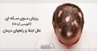 ریزش موی سکه ای ( آلوپسی آره اتا ) علل ابتلا و راههای درمان