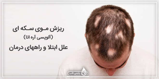 ریزش موی سکه ای ( آلوپسی آره اتا ) علل ابتلا و راههای درمان
