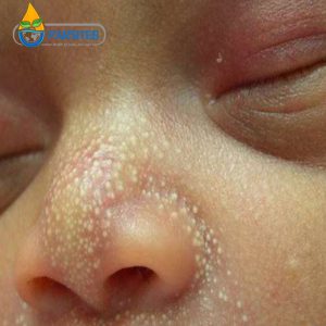 میلیا در نوزادان مشکلات پوستی دانه های ریز اطراف چشم