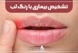 تشخیص بیماری با رنگ لب