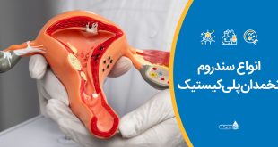 انواع سندروم تخمدان پلی‌کیستیک