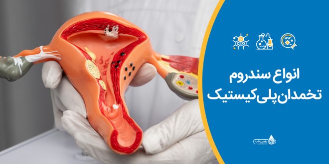 انواع سندروم تخمدان پلی‌کیستیک